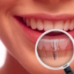 cấy răng implant phương pháp tối ưu