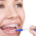 Những điều cần biết về niềng răng