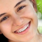 Mặt có lợi khi cho trẻ niềng răng sớm