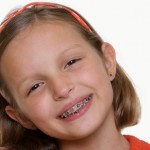 Mặt có lợi khi cho trẻ niềng răng sớm