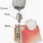 Những phương pháp làm răng giả chất liệu sứ