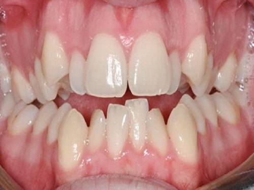 Ưu điểm của kỹ thuật niềng răng với mắc cài 3M UGSL-1
