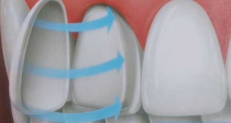 Răng sứ Veneer có ưu điểm là gì?