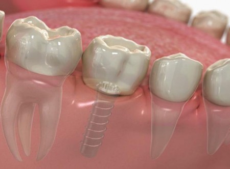 Chọn nha khoa uy tín để cấy ghép implant răng hàm-2