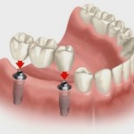 Chọn nha khoa uy tín để cấy ghép implant răng hàm