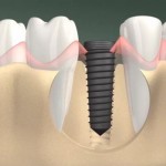 Khi nào nên trồng răng implant?
