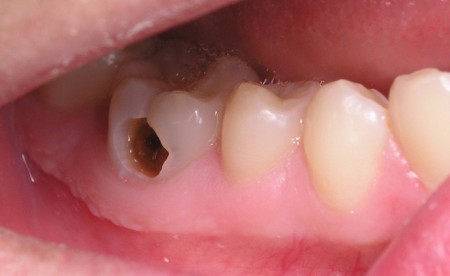 Có nên bọc răng sứ cho răng sâu ?