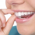 Niềng răng invisalign có gặp bất tiện nào không?