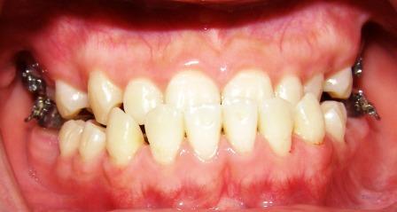 Điều trị niềng răng móm có phải nhổ răng không? 1
