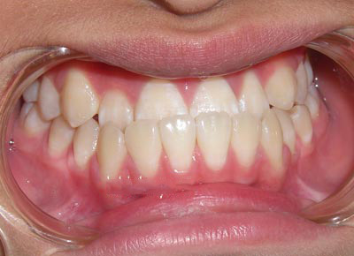 Điều trị niềng răng móm có phải nhổ răng không? 2
