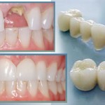 Sử dụng răng giả bằng sứ phục hình răng bị mất