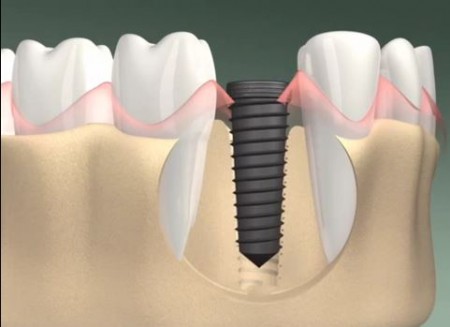 Trồng răng implant mất bao lâu? 1