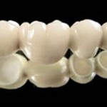 Phục hình răng giả với răng sứ