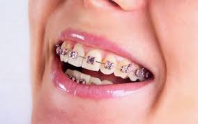 Thẩm mỹ hàm răng không cần phẫu thuật 1