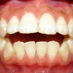Nên làm gì khi răng bị hô hai hàm?
