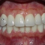 Quy trình đầy đủ thẩm mỹ răng nhiễm tetracycline