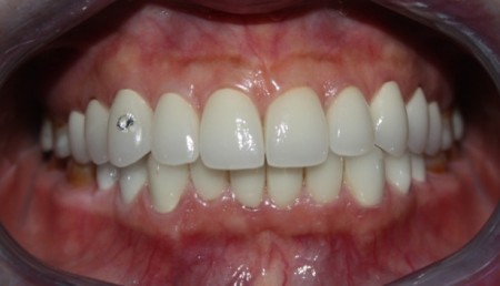 Quy trình đầy đủ thẩm mỹ răng nhiễm tetracycline 