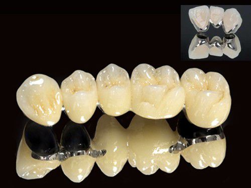 Các loại mão răng sứ-2