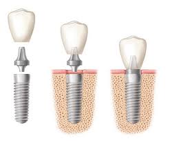 Trồng răng với phương pháp cấy ghép implant