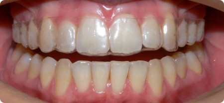 Cách chăm sóc hàm răng sau khi tháo mắc cài-2