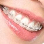 Cách chăm sóc hàm răng sau khi tháo mắc cài