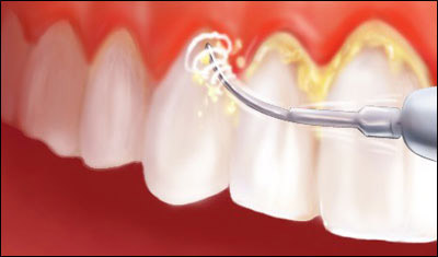 Điều trị viêm tủy răng có hiệu quả không-1