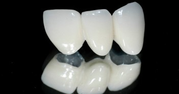 Các cách chăm sóc răng sứ thẩm mỹ không thể bỏ qua