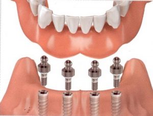 Cẩm nang cho quá trình trồng răng implant-3