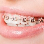 Phương pháp điều trị niềng răng thẩm mỹ