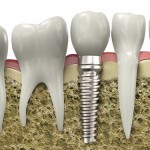 Thế nào là giải pháp phục hình răng tốt nhất?
