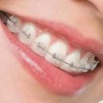 Niềng răng hay bọc răng sứ khi bị hô răng