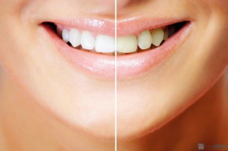 Quy trình tẩy trắng răng và các phương pháp áp dụng-2
