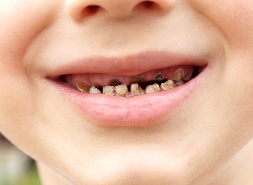 Vì sao răng trẻ bị đen-1