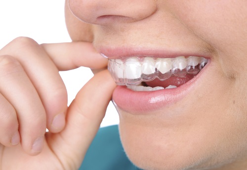 Ưu điểm của phương pháp chỉnh nha niềng răng không nhổ răng-1