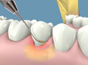 Cạo vôi răng có bị chảy máu không bác sĩ? 2