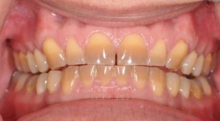 Nên tẩy trắng răng bằng phương pháp nào? 3