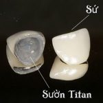 Răng sứ titan giá bao nhiêu tiền là chuẩn?