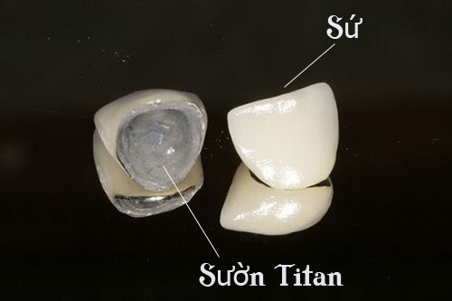 Răng sứ titan giá bao nhiêu tiền là chuẩn? 1