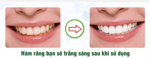 Phương pháp tẩy trắng răng có đau không? 1