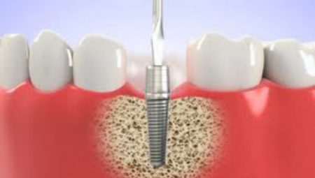 Làm thế nào để biết một địa chỉ trồng răng implant tốt? 3