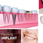 Trồng răng implant có nguy hiểm không? 2