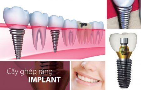 Trồng răng implant có nguy hiểm không? 2