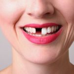 Phương pháp trồng răng sứ vĩnh viễn hiện đại