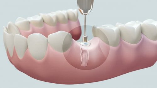 Cấy ghép răng implant là gì? 1