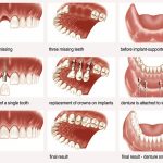 Quá trình cấy ghép implant cho răng hàm như thế nào? 1