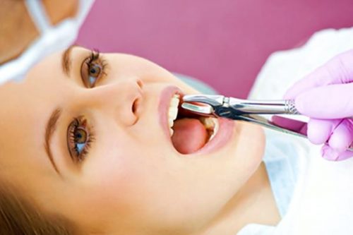 Nhổ răng khôn có nguy hiểm không? 3