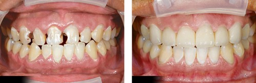 Bọc răng sứ cho răng sâu 1