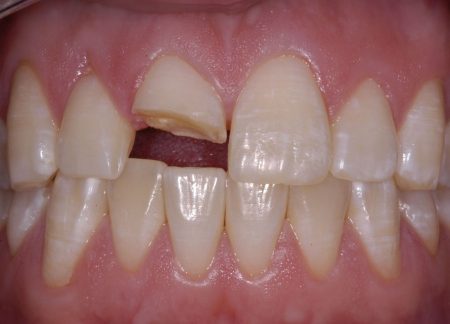 Mài bọc răng sứ có đau không? 3