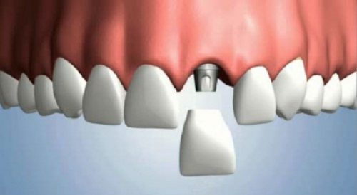 Cấy ghép implant cho răng cửa 3