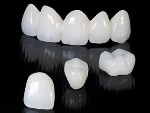 Độ bền của răng sứ thẩm mỹ 3